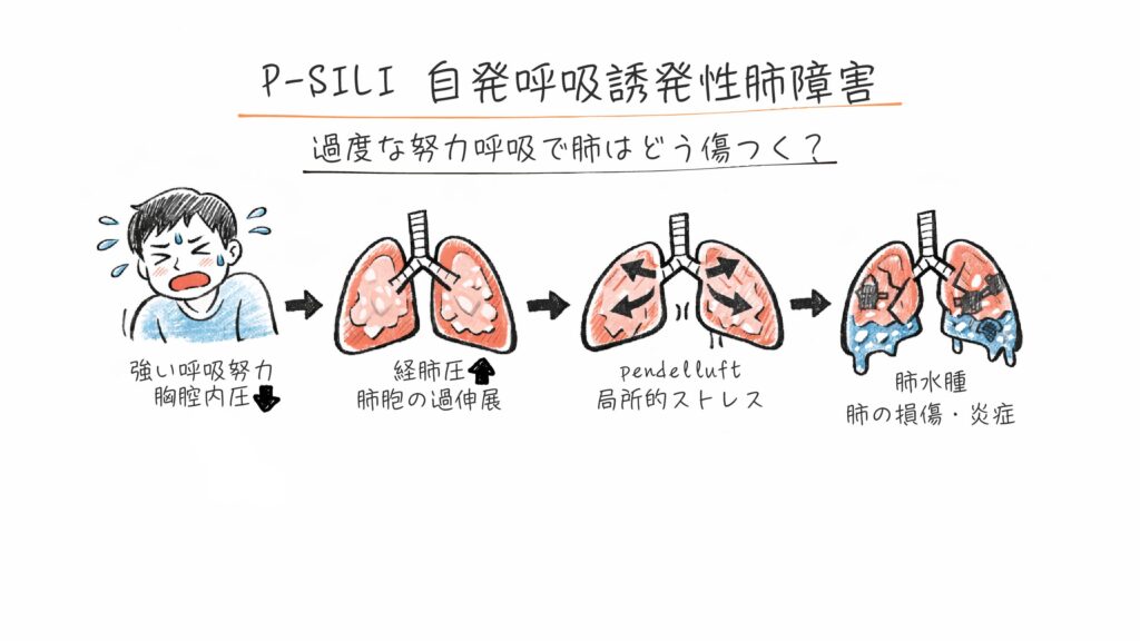 P-SILI（自発呼吸誘発性肺障害についての機序）
