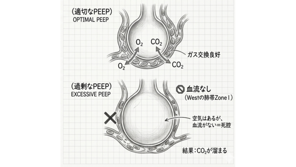 高すぎるPEEPは死腔が増えてCO2が溜まる理由